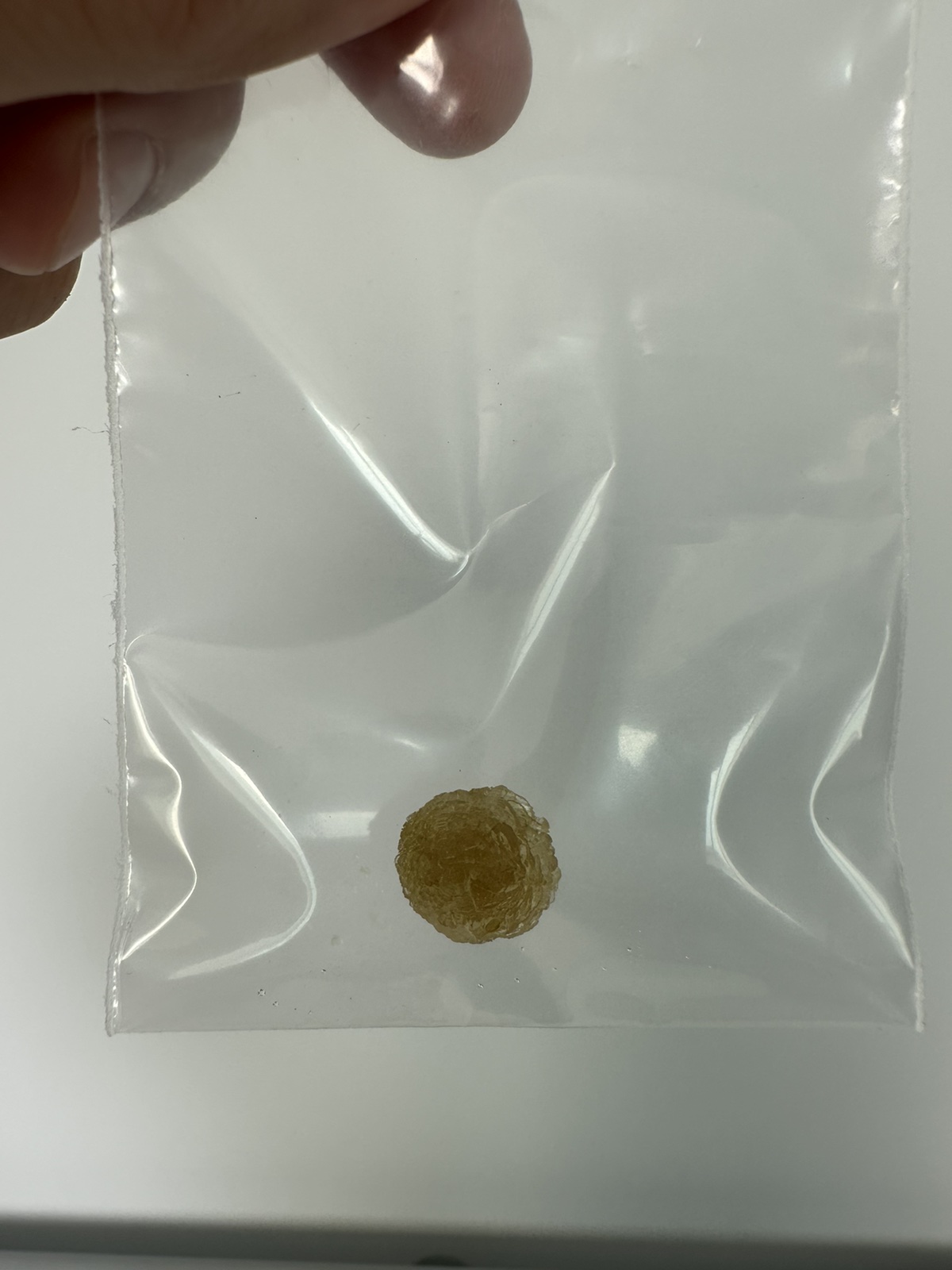 Удаленный камень в желчном